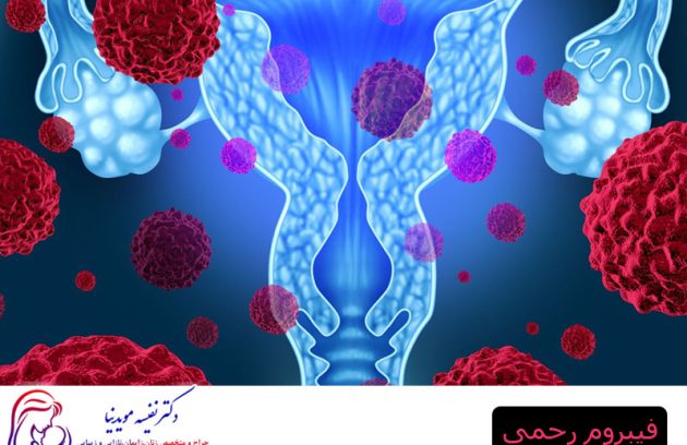 فیبروم رحمی