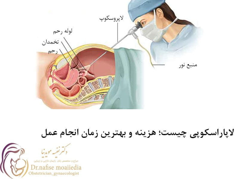 لاپاراسکوپی چیست