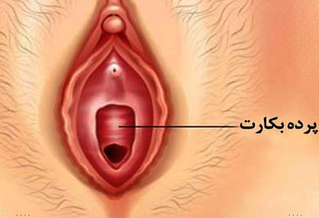 تشخیص-سلامت-پرده-بکارت