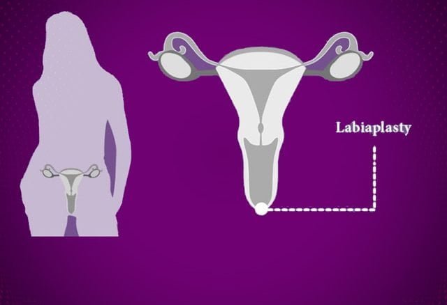عمل ترمیم-لابیاپلاستی