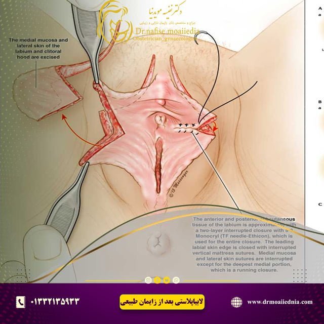 لابیاپلاستی-بعد-از-زایمان-طبیعی