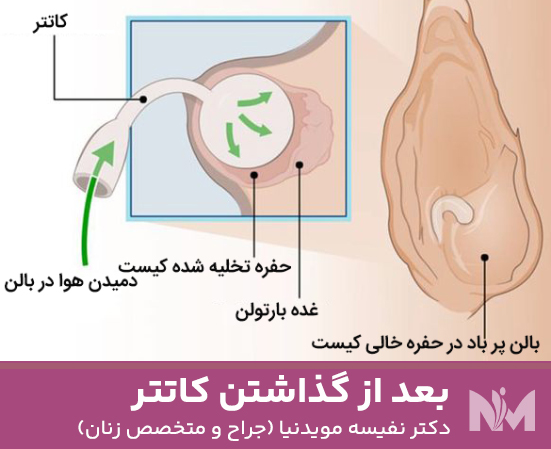 بعد-از-گذاشتن-کاتتر