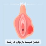 درمان-کیست-بارتولن-در-رشت