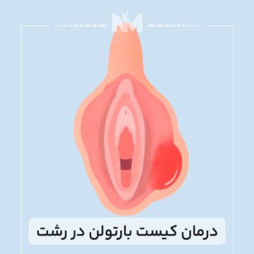 درمان-کیست-بارتولن-در-رشت