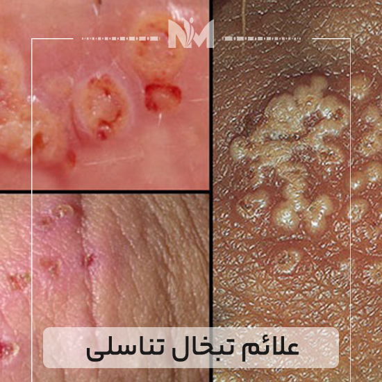 علائم-تبخال-تناسلی