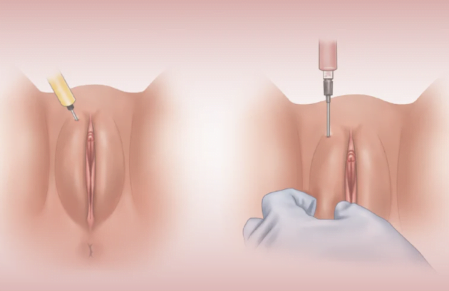 تزریق چربی به واژن توسط دکتر نفیسه مویدنیا