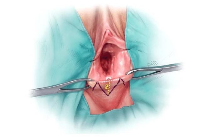 جراحی پرینورافی واژن