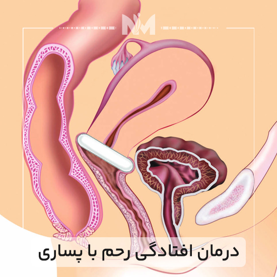 درمان-افتادگی-رحم-با-پساری