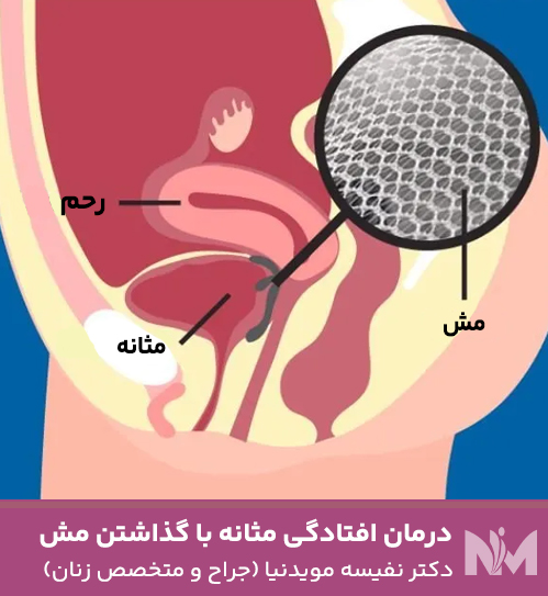 درمان-افتادگی-مثانه-با-گذاشتن-مش