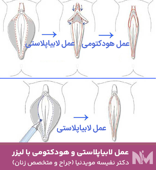 عمل-لابیاپلاستی-و-هودکتومی-با-لیزر