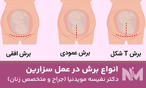 انواع-برش-در-عمل-سزارین