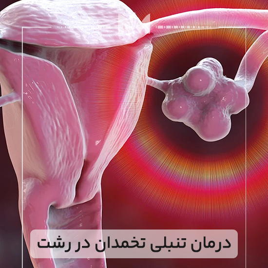 درمان-تنبلی-تخمدان-در-رشت