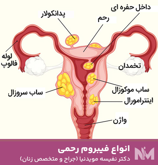 انواع-فیبروم-رحمی