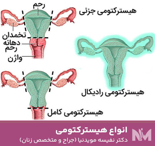 انواع-هیسترکتومی