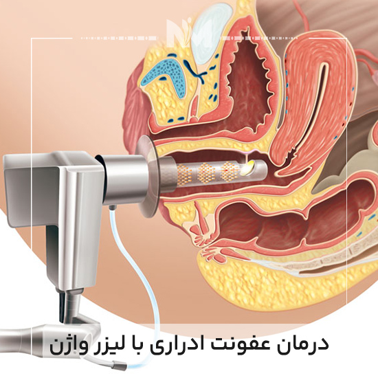 درمان-عفونت-ادراری-با-لیزر-واژن