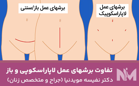 تفاوت-برشهای-عمل-لاپاراسکوپی-و-باز