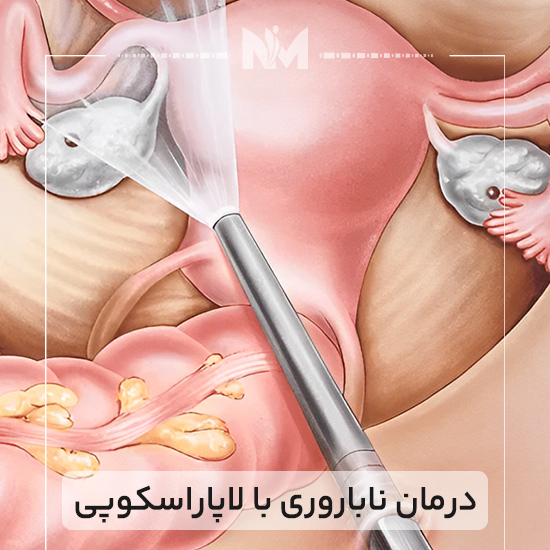 درمان-ناباروری-با-لاپاراسکوپی