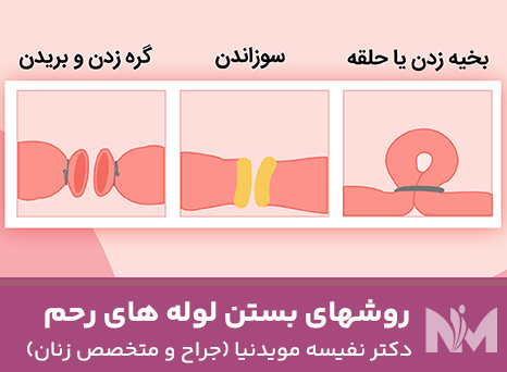 روشهای-بستن-لوله-های-رحم