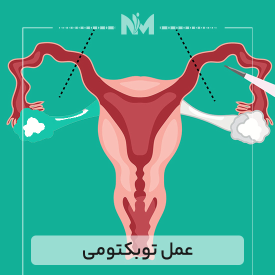 عمل-توبکتومی