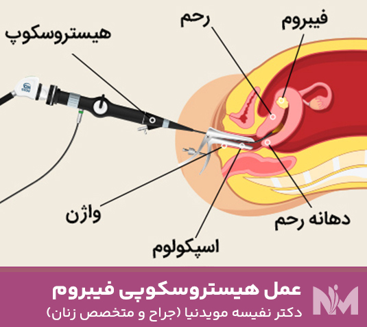 عمل-هیستروسکوپی-فیبروم