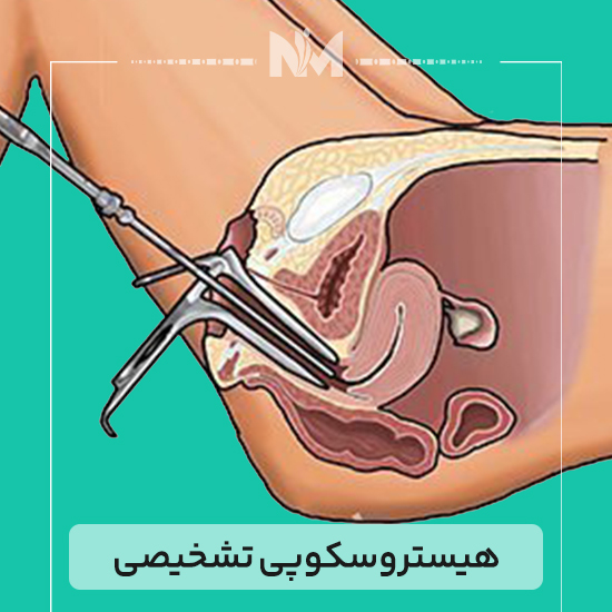 هیستروسکوپی-تشخیصی