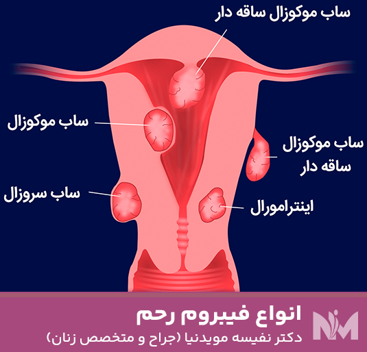 انواع-فیبروم-رحم