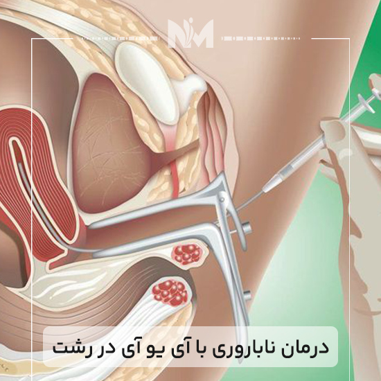 درمان-ناباروری-با-آی-یو-آی-در-رشت