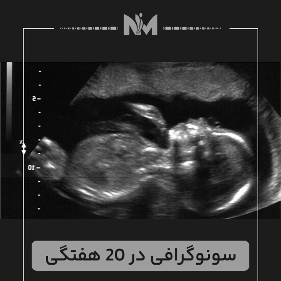 سونوگرافی-در-20-هفتگی