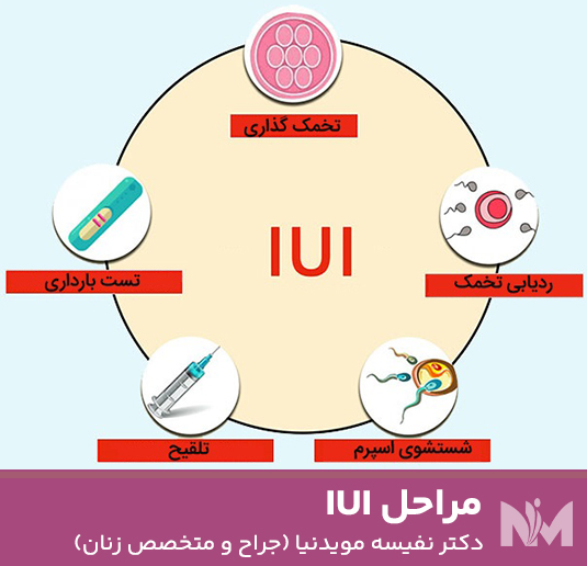 مراحل-IUI