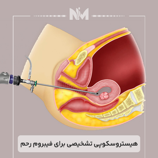 هیستروسکوپی-تشخیصی-برای-فیبروم-رحم