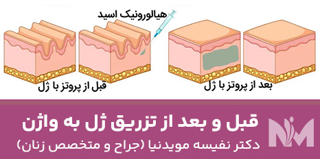 قبل-و-بعد-از-تزریق-ژل-به-واژن