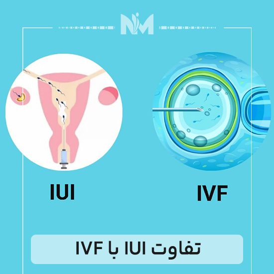 تفاوت-IUI-با-IVF