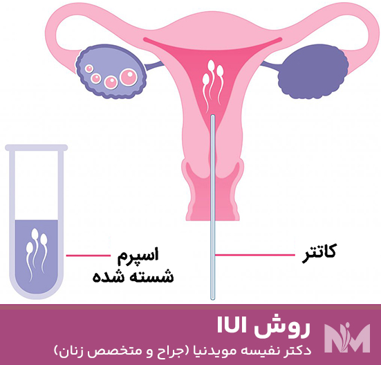 روش-IUI