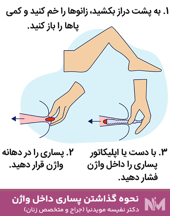 نحوه-گذاشتن-پساری-داخل-واژن