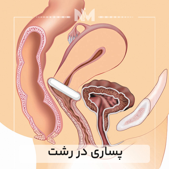 پساری-در-رشت