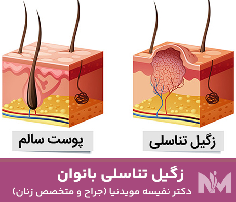 زگیل-تناسلی-بانوان