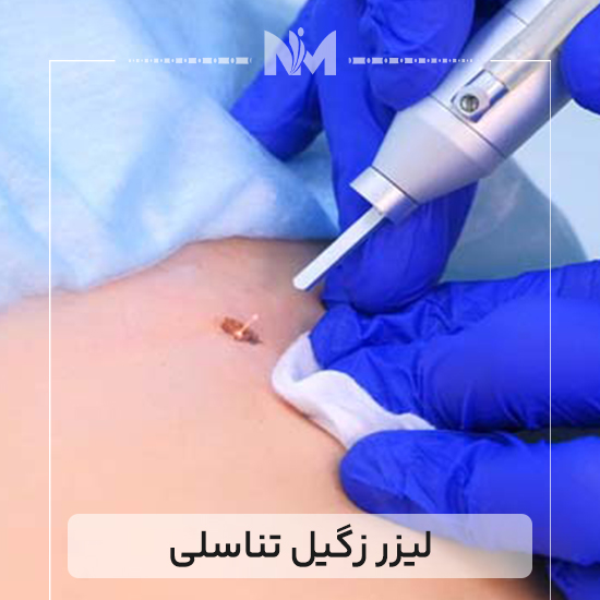 لیزر-زگیل-تناسلی