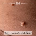 لیزر-زگیل-تناسلی-زنان-در-رشت